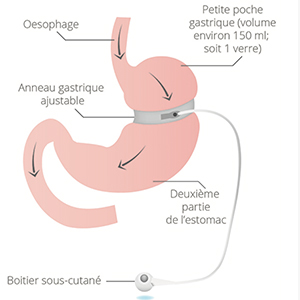 anneau-gastrique-tunisie