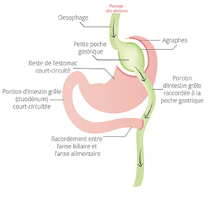 bypass-gastrique-tunisie