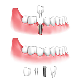 implants dentaire tunisie