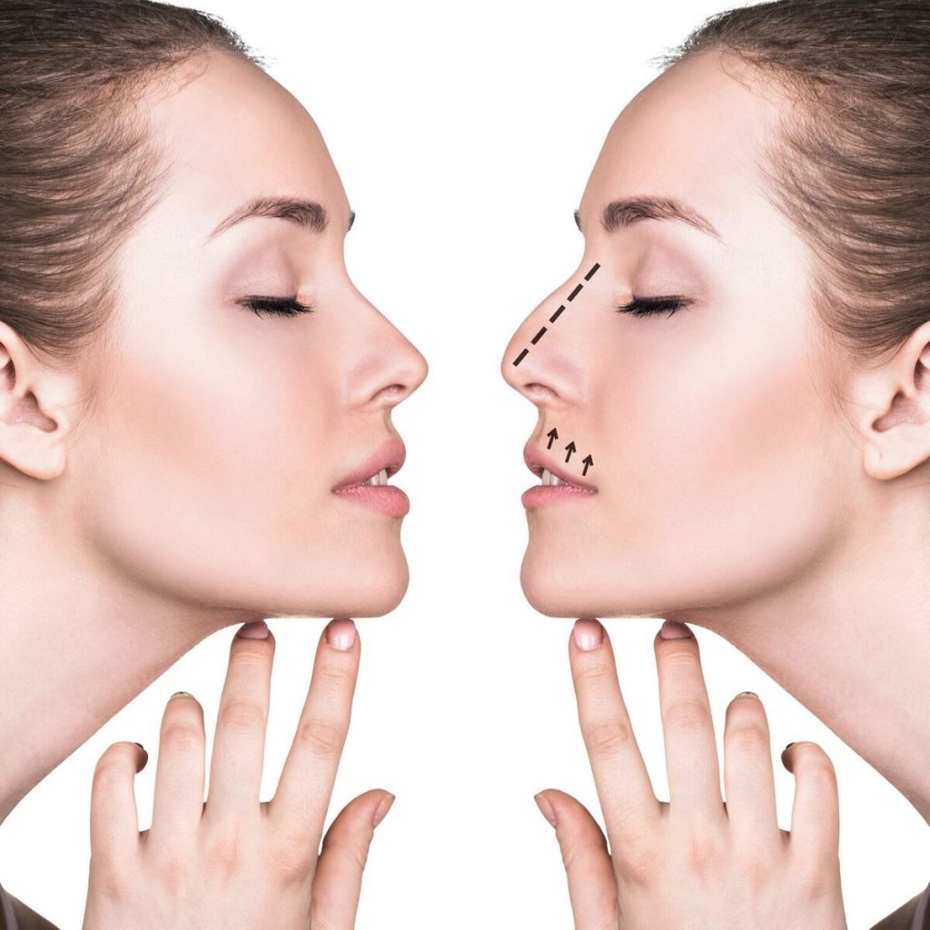 rhinoplastie