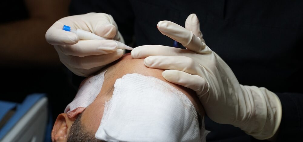 Découvrez les étapes essentielles de la greffe de cheveux DHI en Tunisie, une méthode avancée pour restaurer une chevelure dense et naturelle. Ce processus inclut l'anesthésie locale, l’extraction des follicules à partir de la zone donneuse, l’implantation directe des greffons dans la zone de calvitie, et des soins post-opératoires rigoureux pour garantir une récupération optimale et des résultats durables.