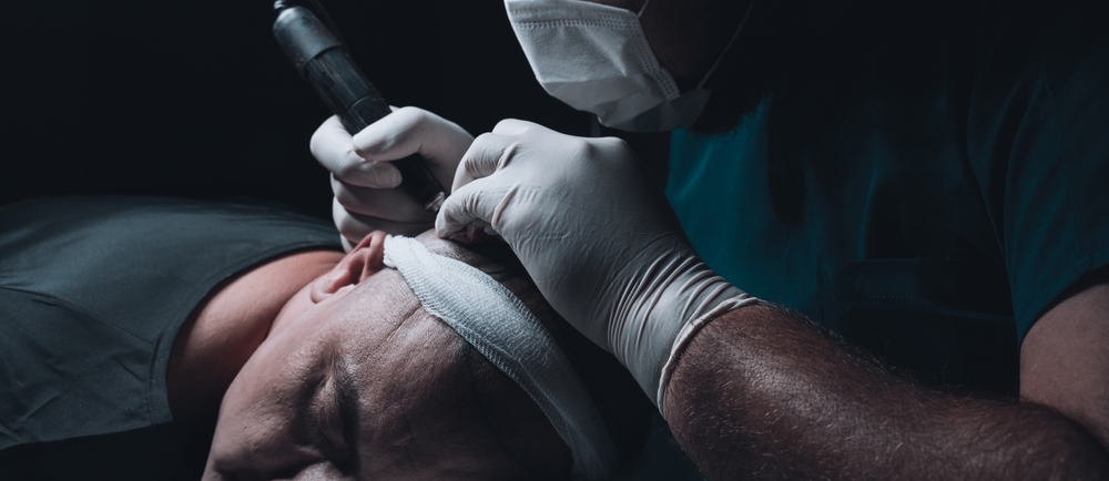 Image illustrating the FUE greffe capillaire en Tunisie, une technique moderne de transplantation capillaire pour des résultats naturels et sans cicatrices visibles.