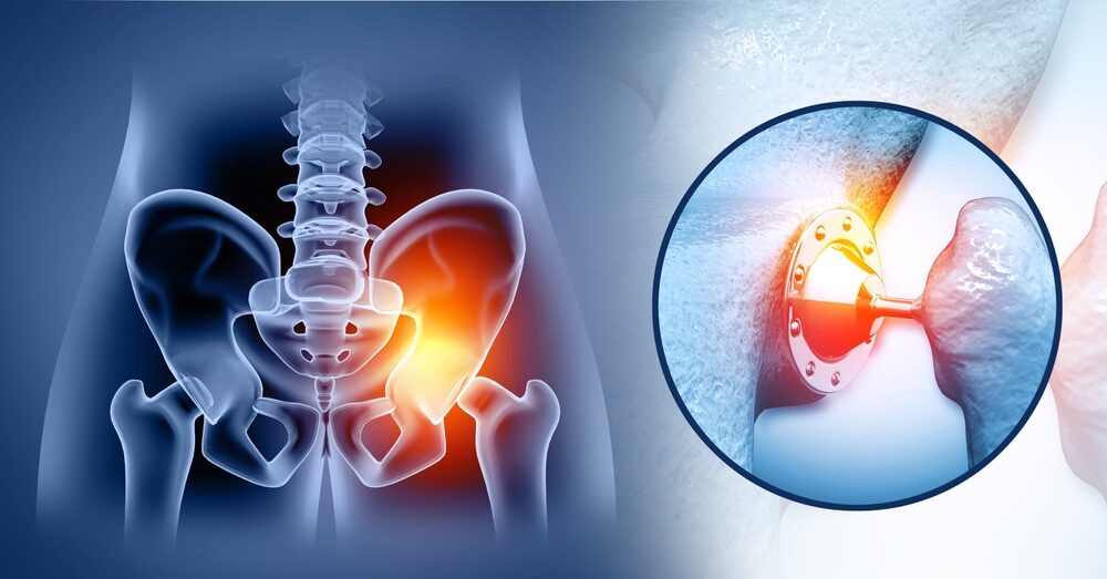 Hip,Implant,,Artificial,Joint.,3d,Illustration