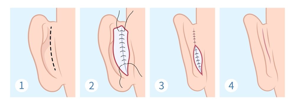 Derrière l'oreille en chirurgie esthétique pour la beauté