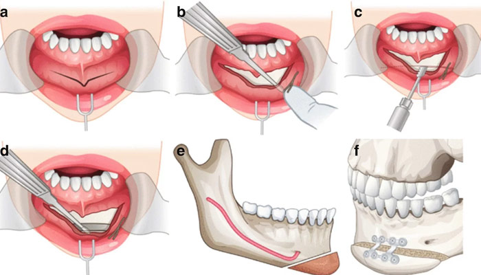 Comment se déroule une génioplastie ? 