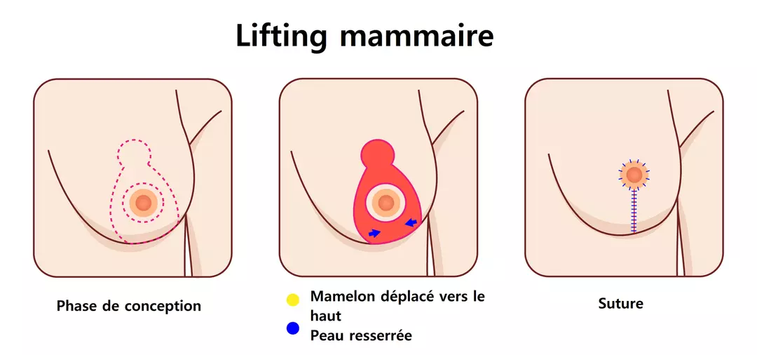 Un schéma illustrant les étapes du processus de lifting mammaire, incluant les incisions et la reposition des tissus mammaires pour obtenir un résultat plus ferme et naturel.