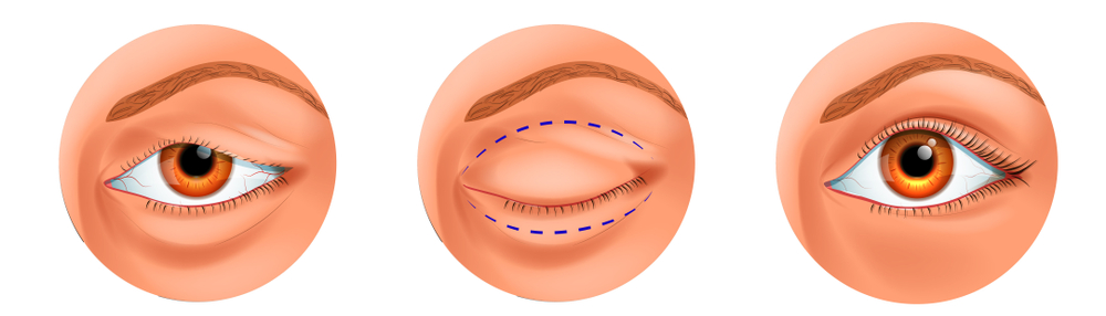 illustration vectorielle de blépharoplastie de la paupière surpenchée