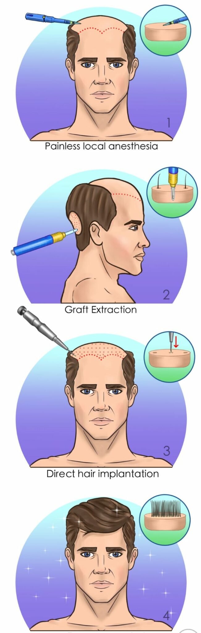 Illustration du processus de la greffe de cheveux DHI en Tunisie, montrant les étapes clés de l'extraction et de l'implantation des follicules pileux à l'aide de l'implanteur DHI, avec des détails sur l'anesthésie locale et la précision de l'implantation pour des résultats naturels.