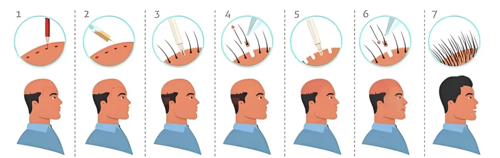 Illustration décrivant les étapes du processus de greffe de cheveux Sapphire, y compris l'anesthésie locale, l'extraction des follicules, l'ouverture des canaux avec des lames en saphir, et l'implantation des follicules dans la zone receveuse pour des résultats d’apparence naturelle.