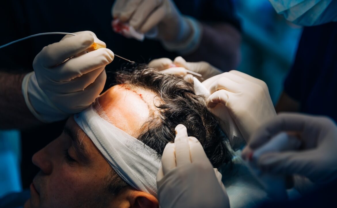 Hair,Transplant,Operation,Process,With,Surgeon.