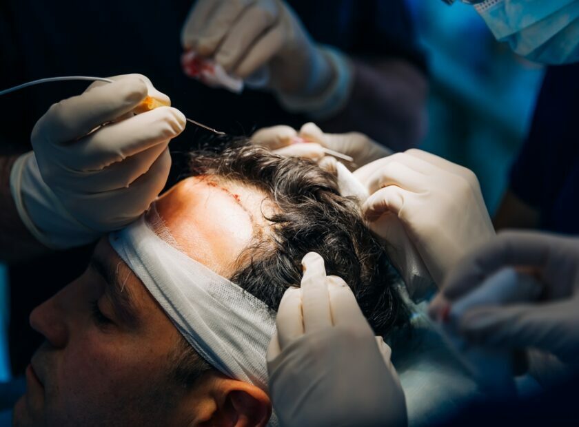 Hair,Transplant,Operation,Process,With,Surgeon.